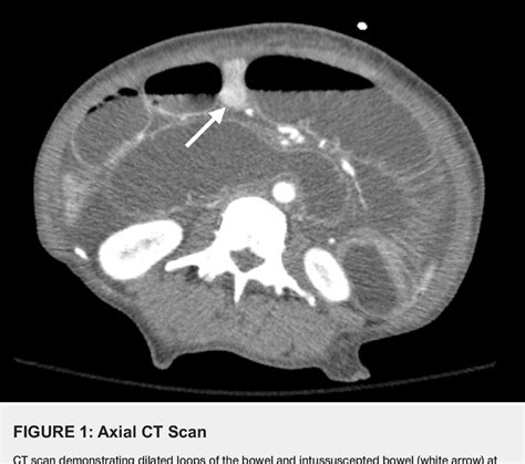 Figure From A Rare Case Of Adult Onset Intussusception Complicated By