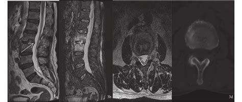 Imaging Features Of Sporadic Brucella Spondylitis In Yunnan Province