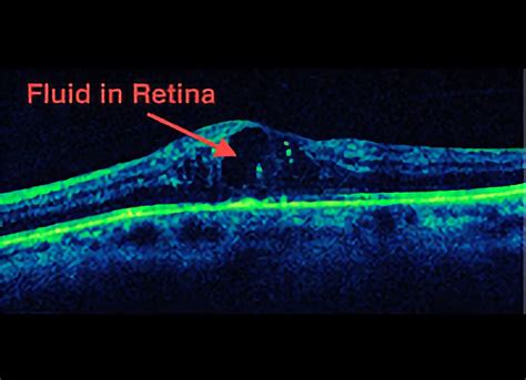 Diabetic Macular Edema Care Retinal Consultants Medical Group