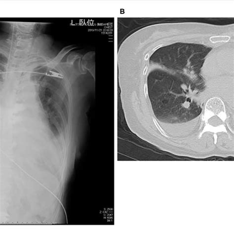 Chest X Ray On Admission A And Chest Computed Tomography During Download Scientific Diagram