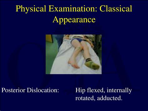 Ppt Hip Dislocations And Femoral Head Fractures Powerpoint