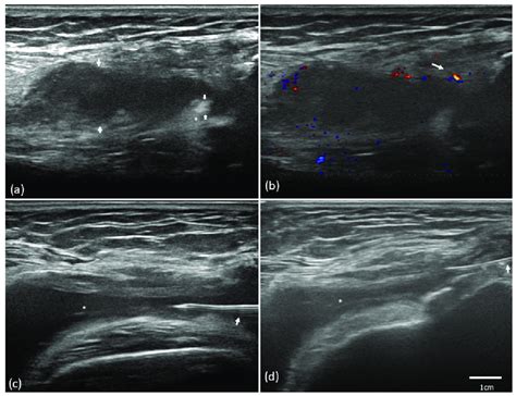 Ultrasound Evaluation Of Synovitis And Ultrasound Guided Administration