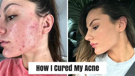 How I Cured My Acne Skin Care And Real Results Youtube