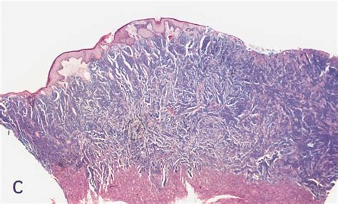 Pathology Outlines Squamous Cell Carcinoma General