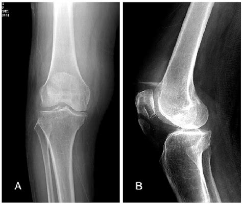 A And B Preoperative Anteroposterior And Lateral Radiographs Showing