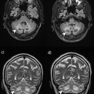 Comparison Of CNS Lesions On MRI Patient 1 Before And After 9 Months