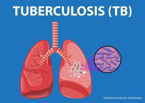 Mengenal Penyakit Tbc Penyebab Gejala Dan Langkah Pencegahan Tbc