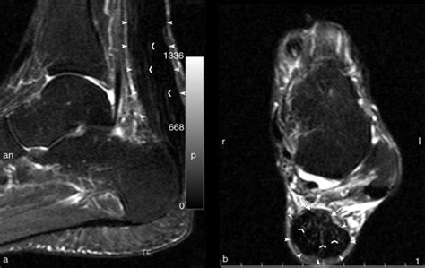 Stir Magnetic Resonance Imaging Of The Achilles Tendo In A Patient With