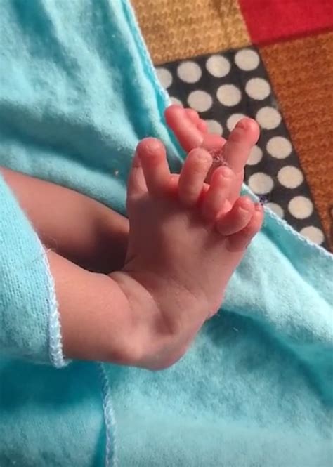 Our Miracle Baby Girl Was Born With 14 Fingers And 12 Toes Shes A