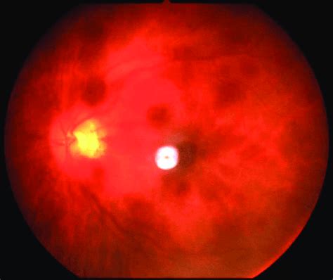 Fundus showing multiple hemorrhages in all four quadrants, optic disc... | Download Scientific ...