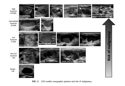 Thyroid Nodules Evms Endocrinology Fellowship