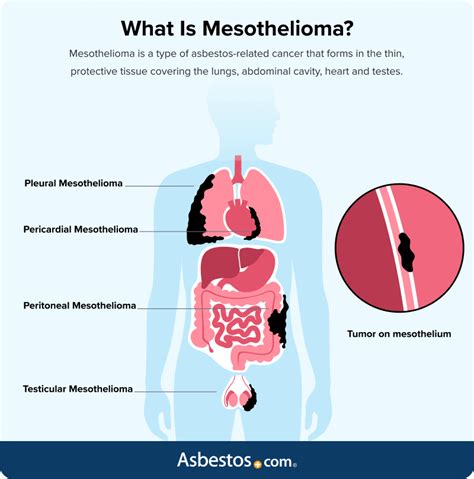 Understanding Mesothelioma Guide For Nursing Medical Students