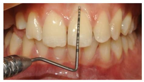 Association Between Gingival Biotype And Facial Typology Through Cephalometric Evaluation And