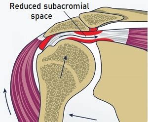 Subacromial Decompression Surgery For Shoulder Impingement