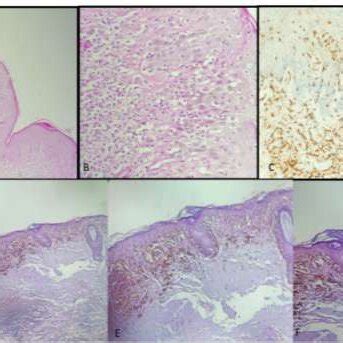 Figure Histological And Immunohistochemical Images Of A Biopsy From