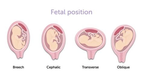 How to identify the fetal position in late pregnancy? | 123sonography