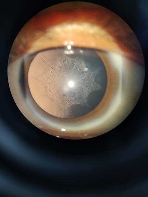 [figure Slit Lamp Examination Under Retroillumination ] Statpearls