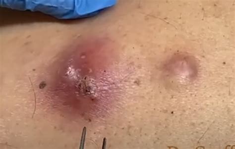 Two Cysts On Back Incision And Drainage New Pimple Popping Videos