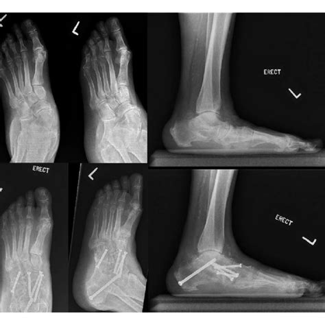 Triple Arthrodesis Surgical Approach By Date After 2009 Only 1