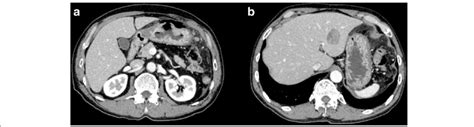 Imaging Findings Abdominal Contrast Enhanced Computed Tomography Download Scientific Diagram