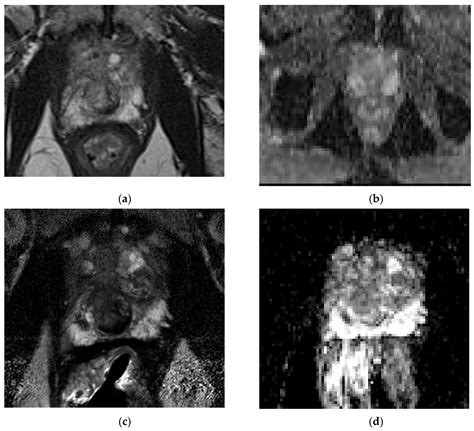 Life Free Full Text Prostate Mri Is Endorectal Coil Necessary—a Review