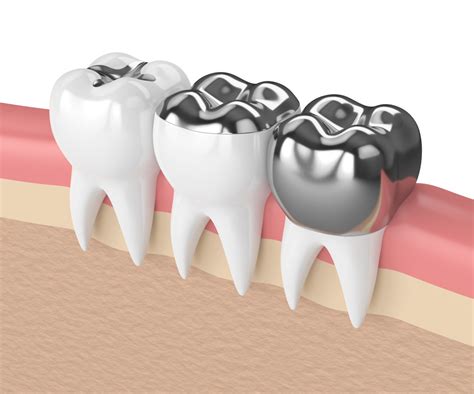 Dental Crowns Everything You Need To Know Nunyara Dental