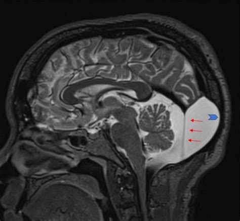 Arachnoid Cyst Radiology Reference Article Radiopaedia Org