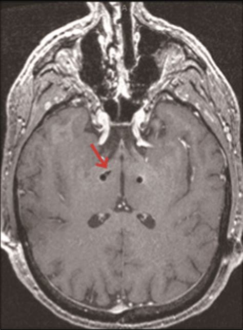 Stn Infarction Adsacent To The Dbs Lead Subthalamic Nucleus Infarction