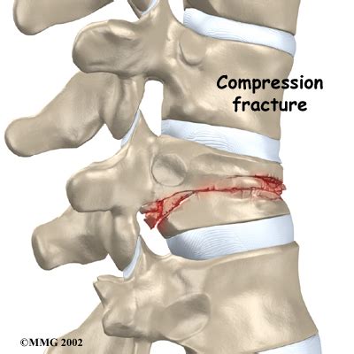 Physical Therapy In Cincinnati And West Chester For Spinal Compression