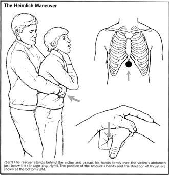 How To Perform The Heimlich Maneuver On Yourself Steps Artofit