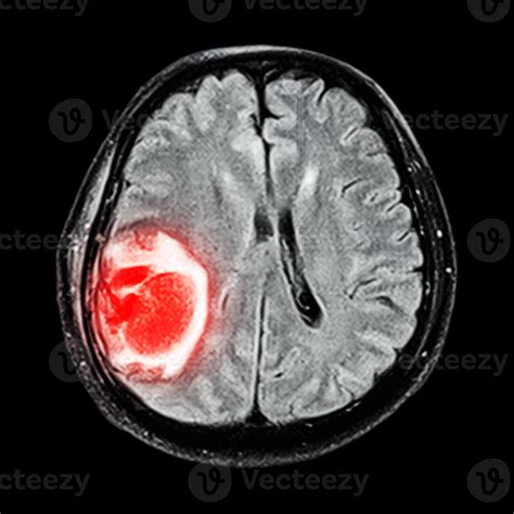 ressonância magnética mostra tumor cerebral no lobo parietal direito do