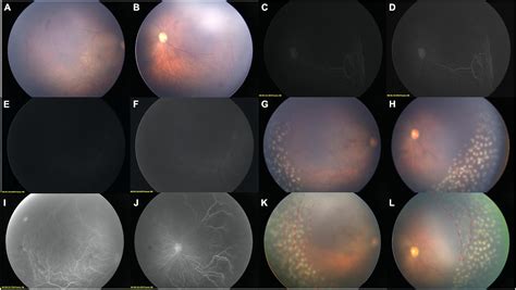 Frontiers Two Step Widefield Fundus Fluorescein Angiography Assisted Laser Photocoagulation In