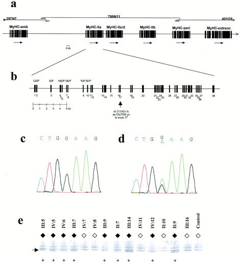 Autosomal Dominant Myopathy Missense Mutation Glu 706 Lys In The