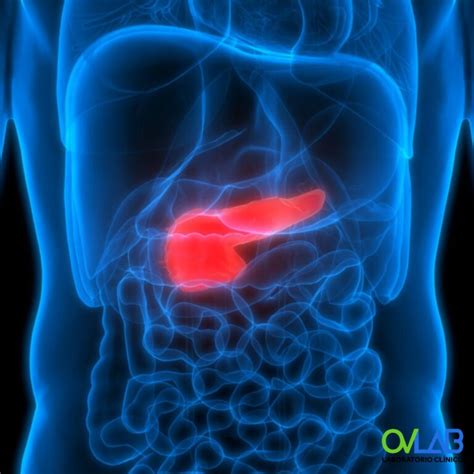 Descarte Diabetes Ovlab O V Laboratorios