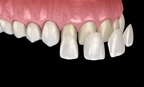 benestar odontologia  motivos  colocar facetas de porcelana