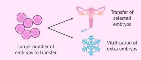 Day 5 Vs Day 3 Embryo Transfer What Are The Pros And Cons