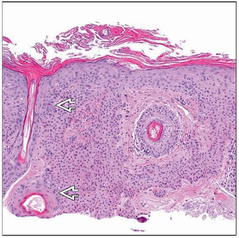 Tumor of the Follicular Infundibulum | Basicmedical Key