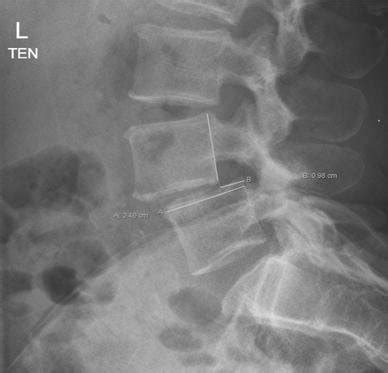 Lateral Lumbar Radiograph Demonstrating Slip Percentage Measurement