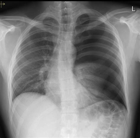 Tension Pneumothorax Radiology At St Vincents University Hospital