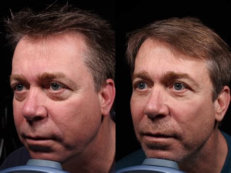 Facial Rejuvenation For Men In Vero Beach