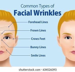 Illustration Two Types Wrinkles Such Mimic Stock Vector Royalty Free