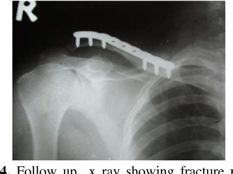 Figure From Analysis Of Displaced Middle Third Clavicular Fractures