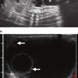 Enteric duplication cyst. (a) Axial fetal US image shows an enteric... | Download Scientific Diagram