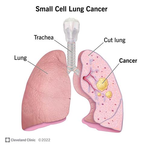 Stage Of Lung Cancer