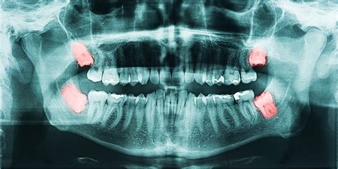 Wisdom Teeth Removal Brisbane Denticine