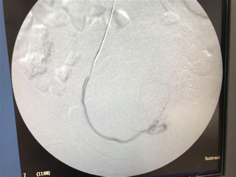 A pretty massive fibroid…this is from a UFE we did I give these women