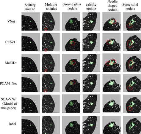 Figure 9 From Multiscale Lung Nodule Segmentation Based On 3D