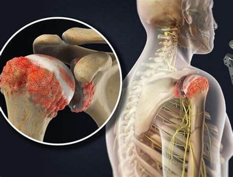 Shoulder Joint Replacement