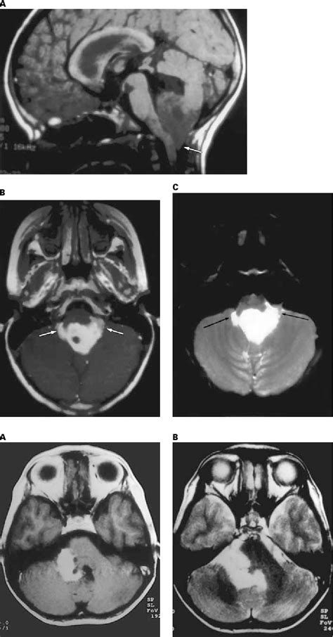 Figure 1 From Mri Features Of Intracranial And Spinal Ependymomas