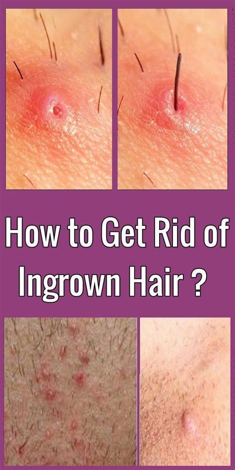 How To Get Rid Of Ingrown Hair Get Rid Of Ingrown Hairs Ingrown